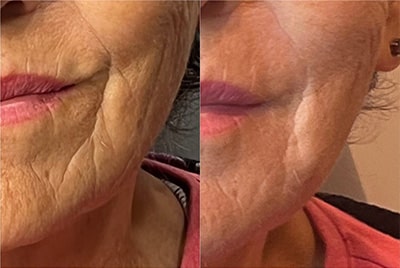 rha3_before-after Botox and fillers at Salora Med Spa Sarasota, FL