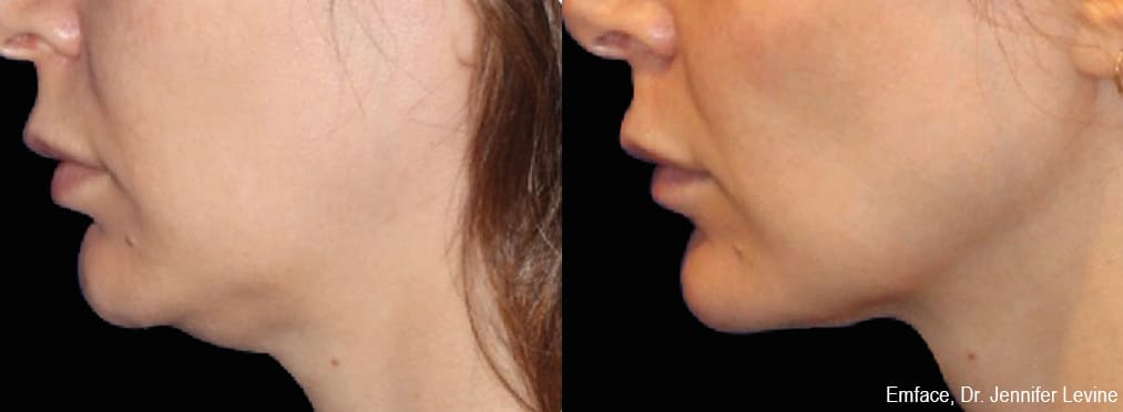 Sirius Med Spa Morpheus8 Body Contouring