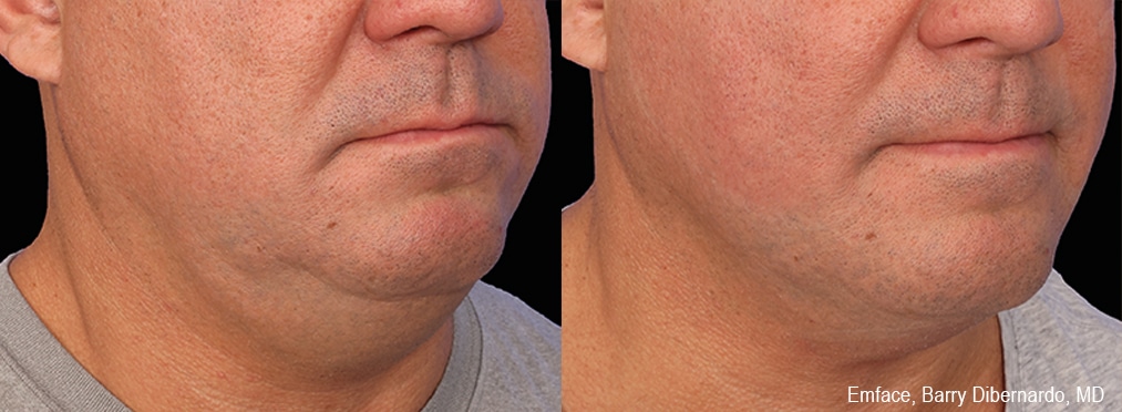 Sirius Med Spa Morpheus8 Body Contouring