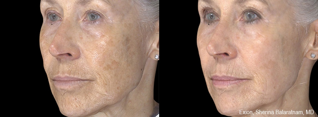 Sirius Med Spa Morpheus8 Body Contouring