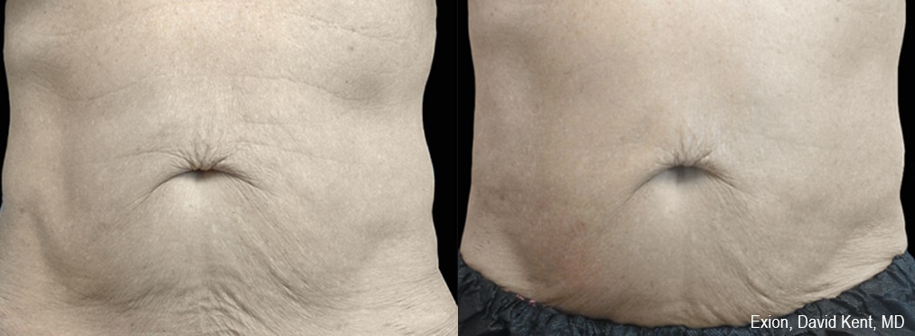 Sirius Med Spa Morpheus8 Body Contouring