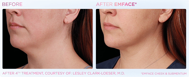 Emface-female-submentum