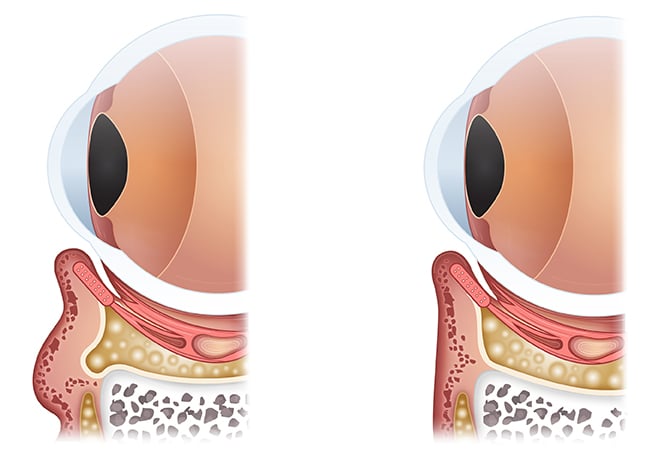 Emface_Eye-Bag_Diagram Exion at Salora Med Spa