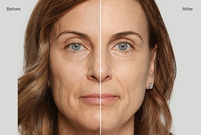 Sculptra at Salora Med Spa