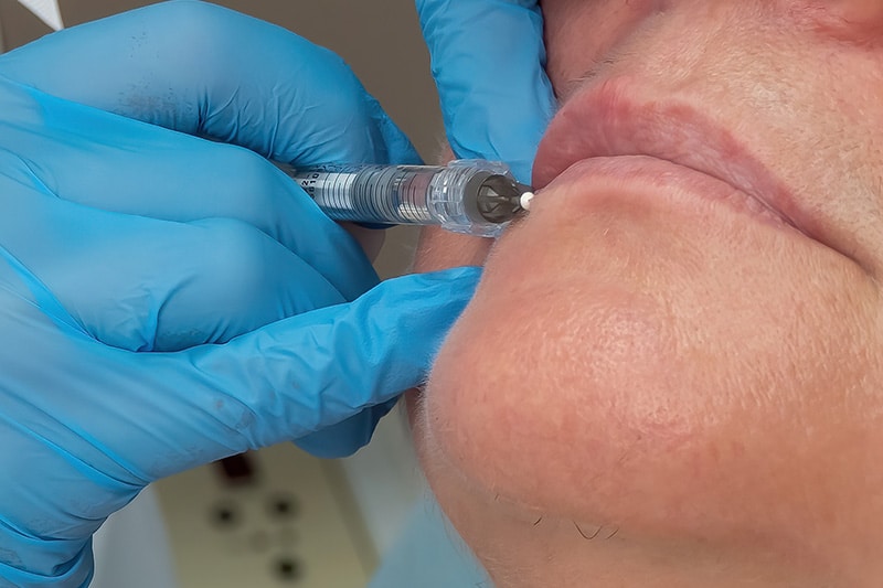 botox-fillers-1 Botox, Dysport, Daxxify, Jeuveau & Dermal Fillers at Salora Med Spa